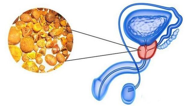 Kalcinace v prostatě
