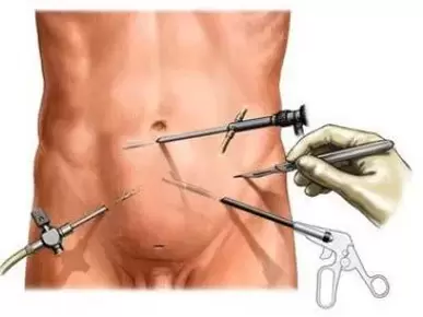 chirurgická léčba chronické prostatitidy