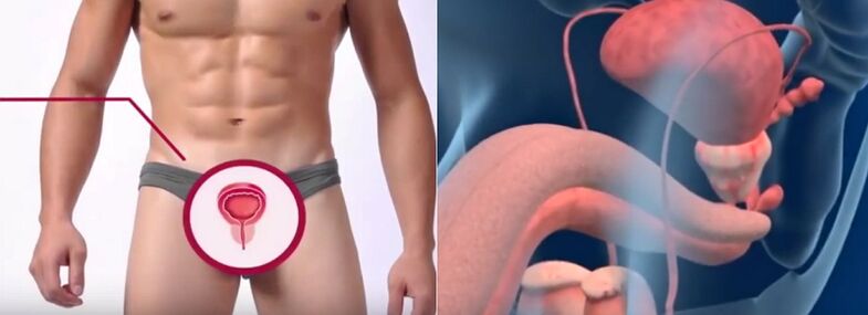 Prostatitida u mužů, rozpoznatelná podle určitých znaků