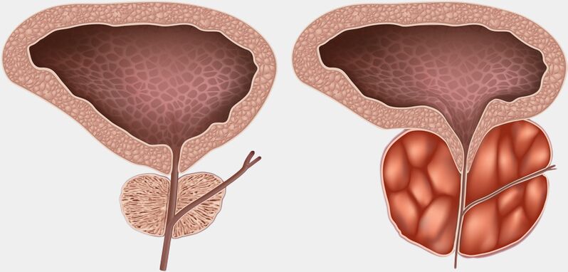 zdravá a zanícená prostata s prostatitidou