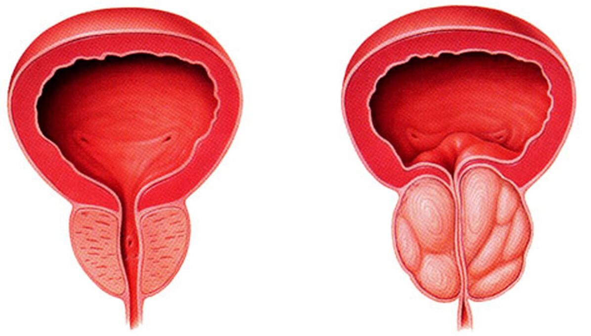 zdravá a zanícená prostata s prostatitidou