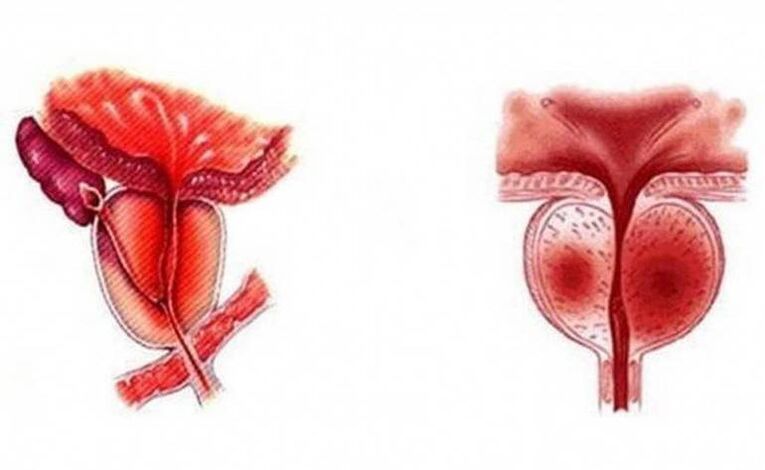 Akutní zánět prostaty, který se může stát chronickým