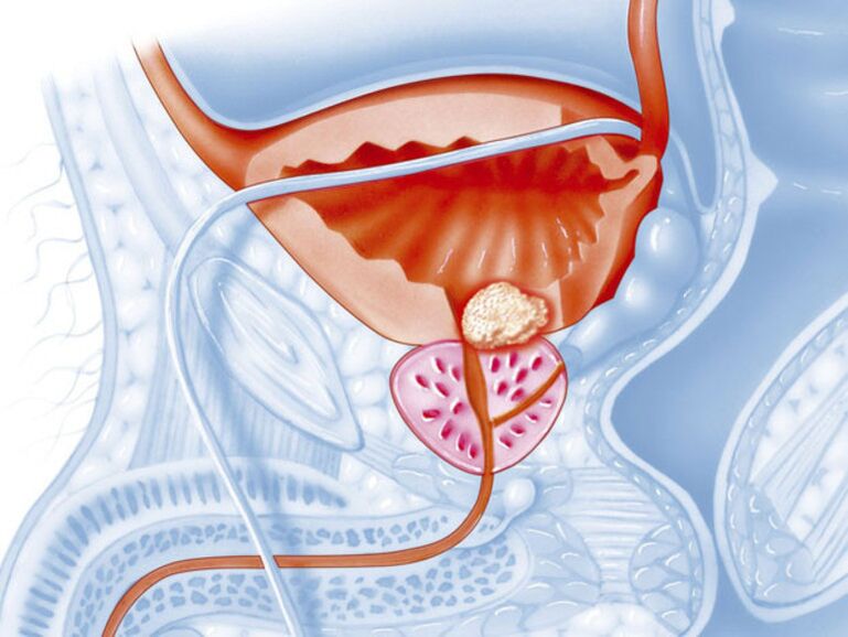 Při chronické prostatitidě se lumen močové trubice zužuje, což ztěžuje odtok moči. 